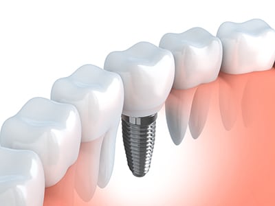 A dental implant shown in the lower jaw