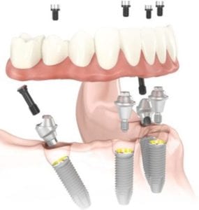 Illustration of an all-on-four dental implants