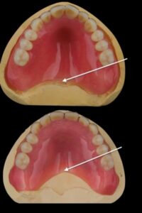 Trimmed denture plate