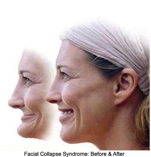before and after facial collpase